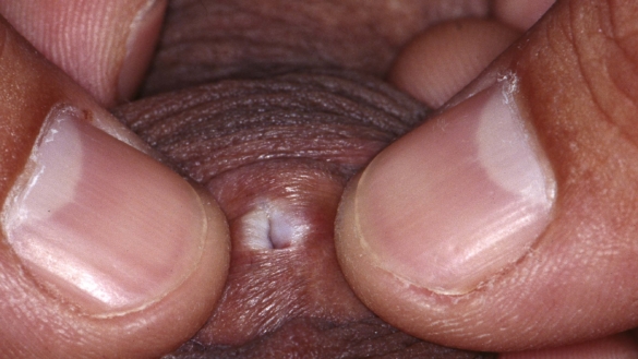 Valkojäkälä (Lichen sclerosus et atrophicus, LSA)